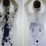Terapia brasileira reduz câncer em quase 90% dos pacientes em estudo