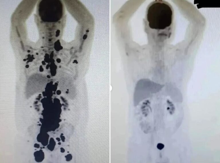 Terapia brasileira reduz câncer em quase 90% dos pacientes em estudo